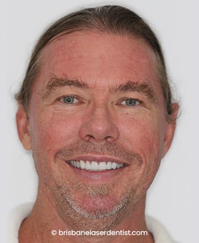 After veneers
